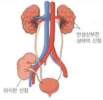 신장이식